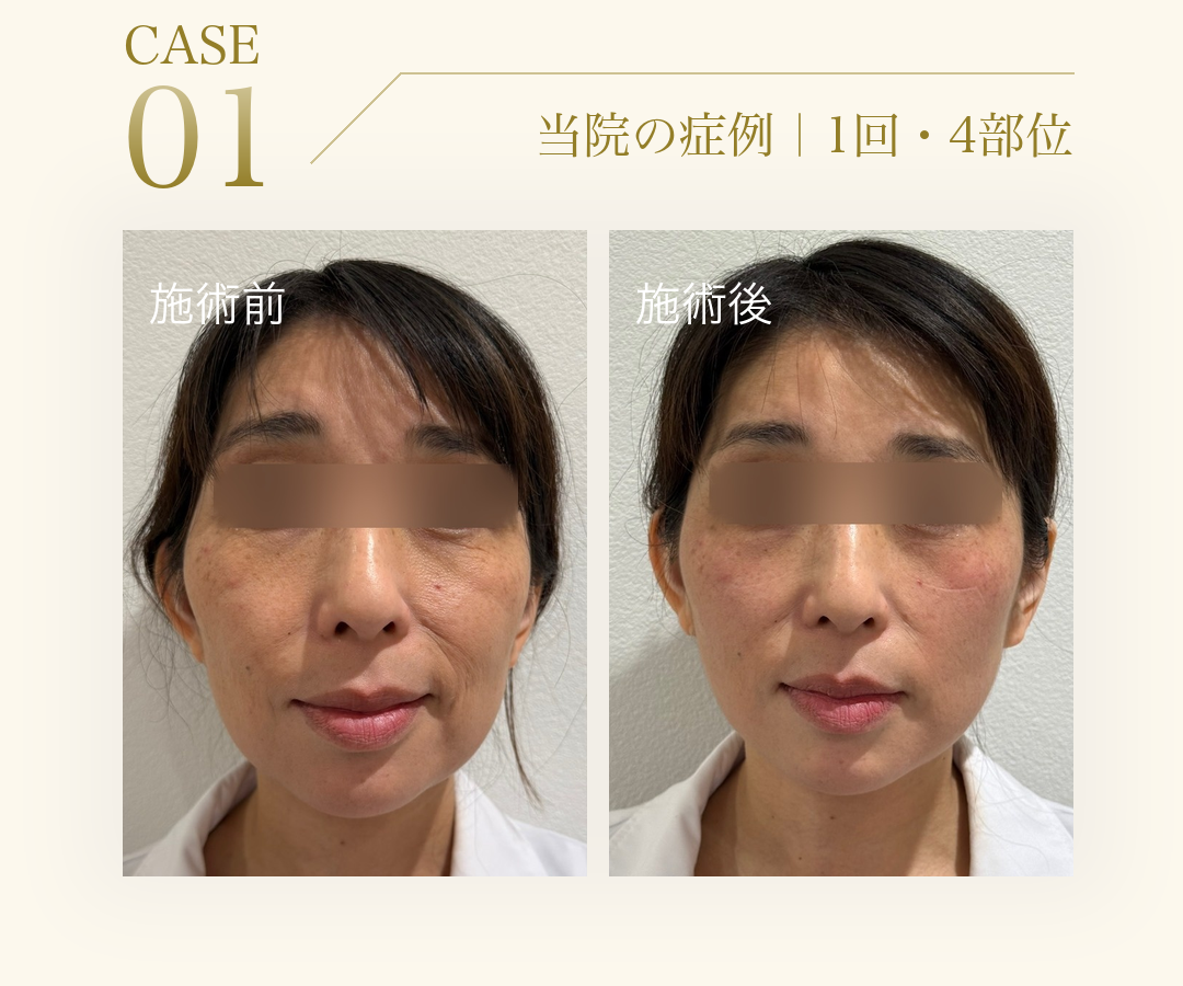 CASE 01。当院の症例。1回・4部位のエムフェイス施術前と施術後の比較写真（正面）。