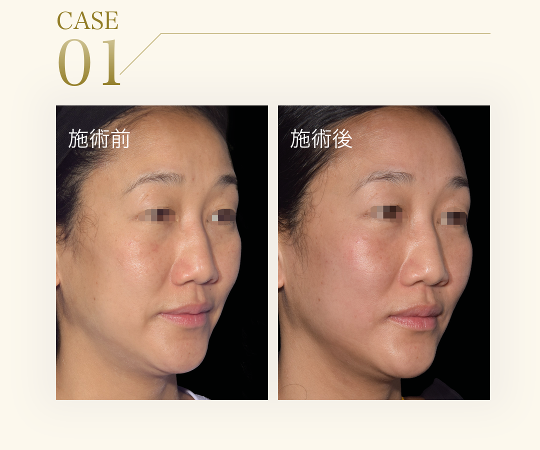 CASE 01。アジア人女性のエムフェイス施術前と施術後の比較写真。