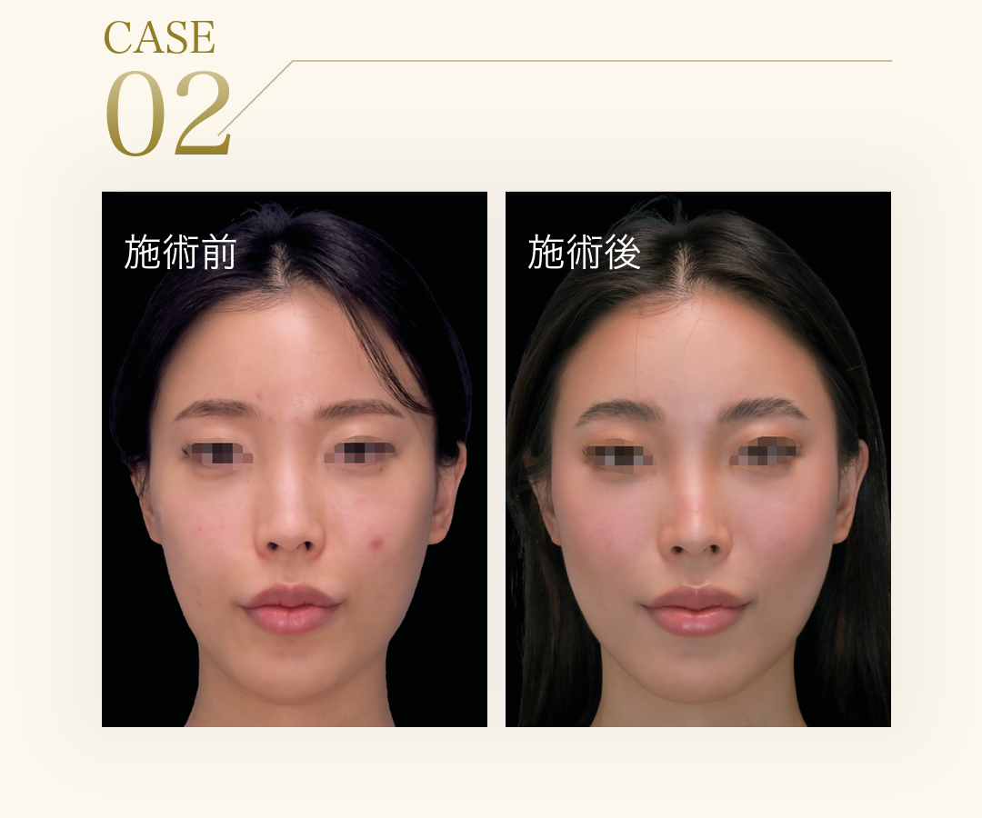 CASE 02。アジア人女性のエムフェイス施術前と施術後の比較写真。