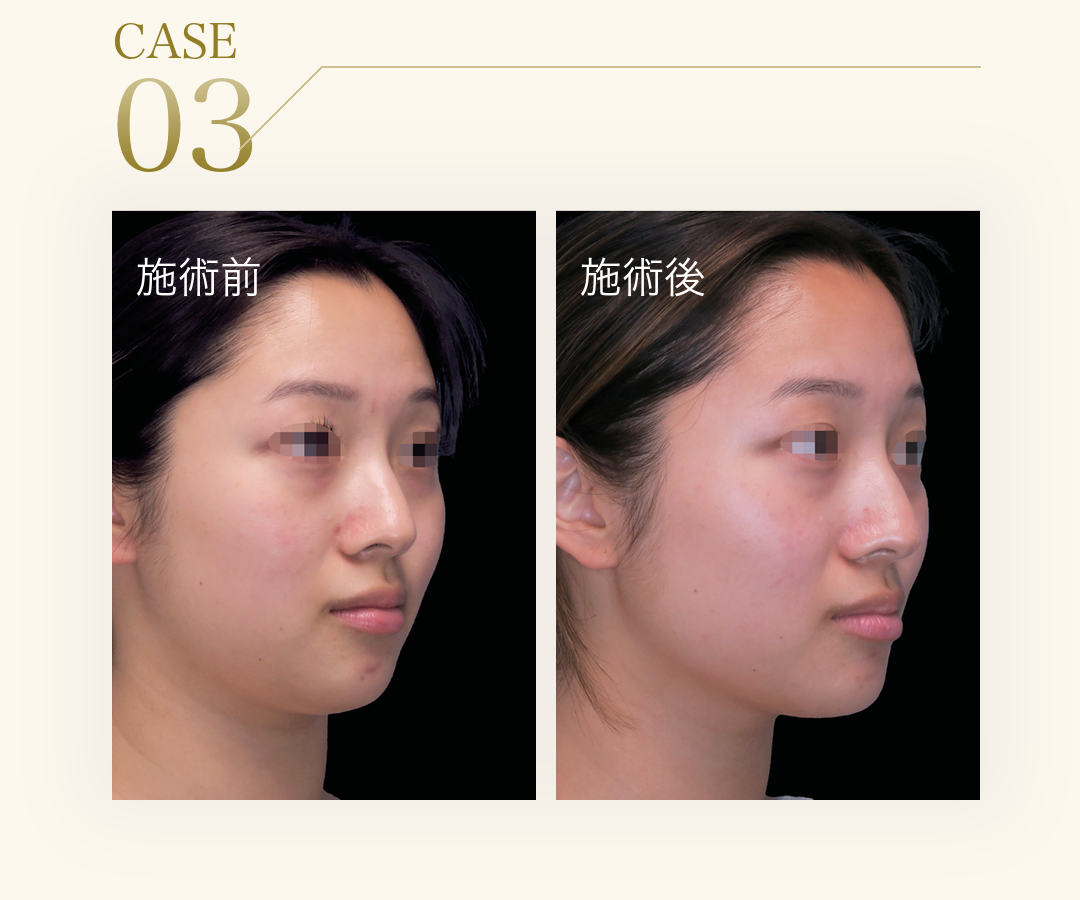 CASE 03。アジア人女性のエムフェイス施術前と施術後の比較写真。